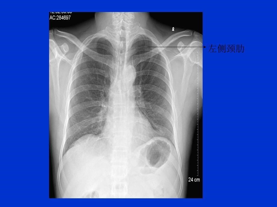 正常X线胸片表现_第5页