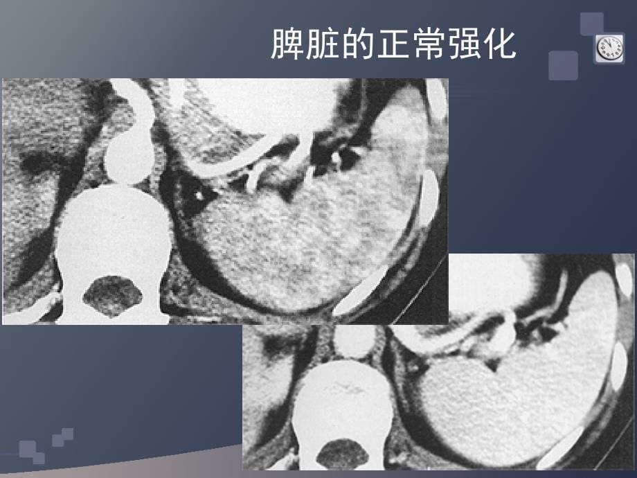 脾脏的正常解剖与影像诊断课件_第5页