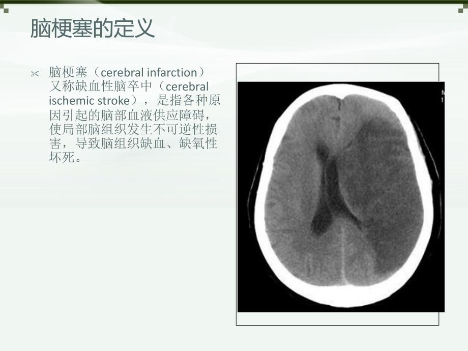 脑梗塞分类与治疗.ppt_第2页