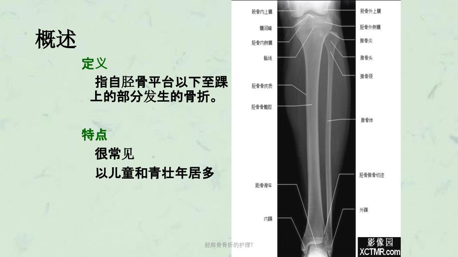 胫腓骨骨折的护理T课件_第4页