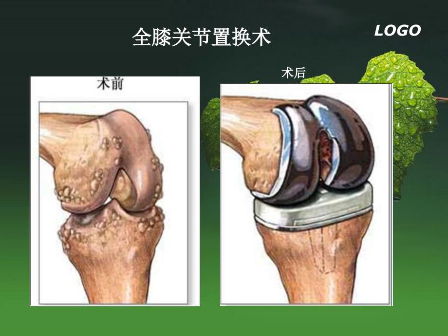 梁静全膝关节置换术后康复描述课件_第4页