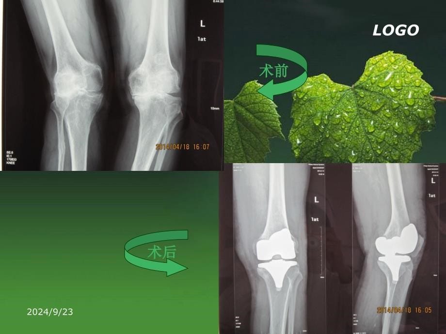 梁静全膝关节置换术后康复描述课件_第5页