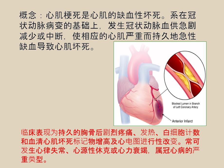 心肌梗死的护理常规.ppt_第2页