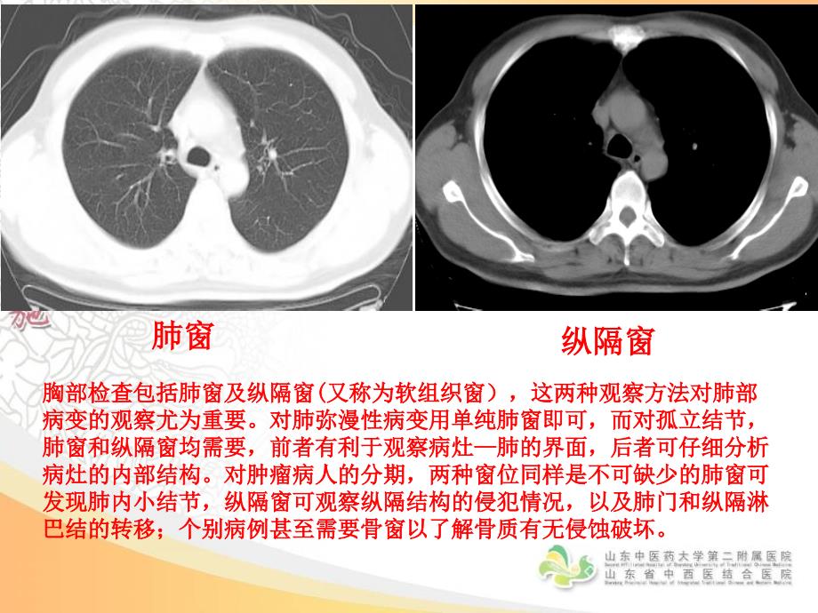 胸部影像学--CT篇_第2页