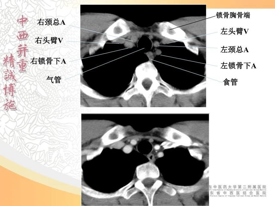 胸部影像学--CT篇_第5页