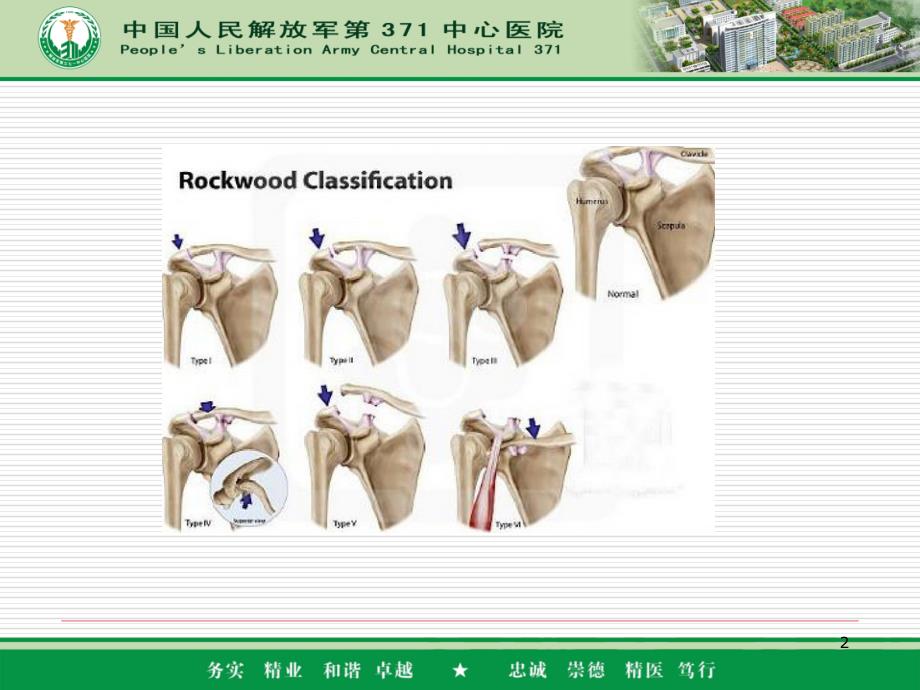 肩锁关节脱位分型及固定方式PPT参考课件_第2页