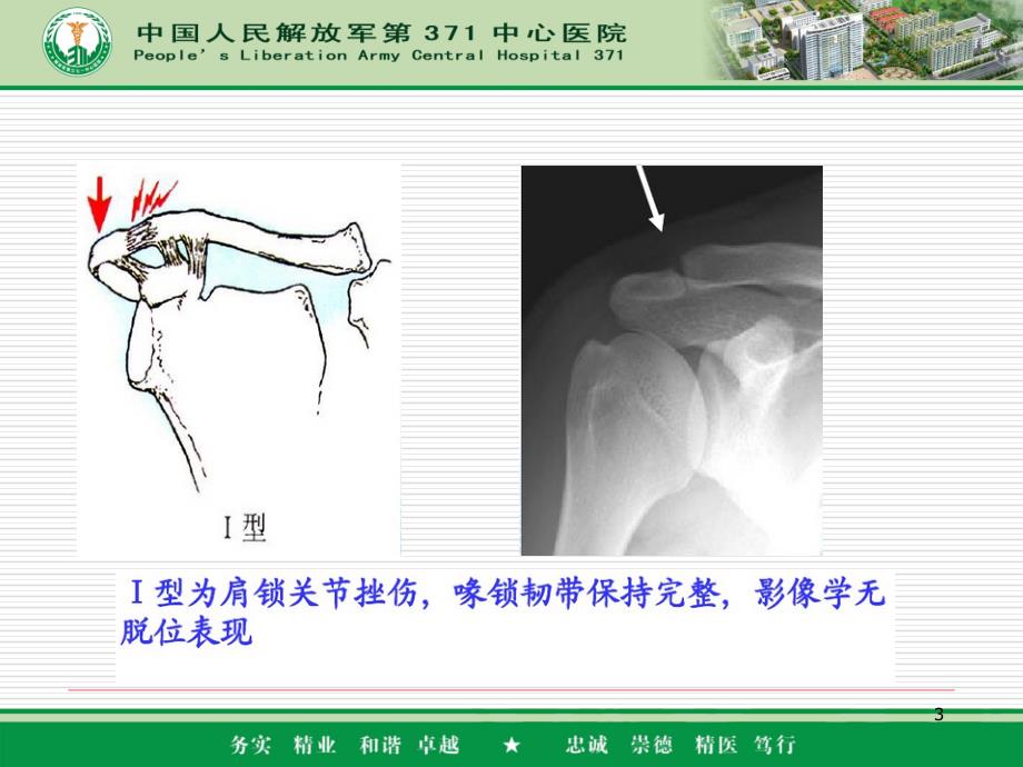 肩锁关节脱位分型及固定方式PPT参考课件_第3页