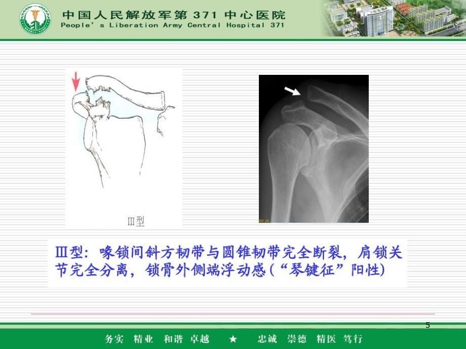 肩锁关节脱位分型及固定方式PPT参考课件_第5页