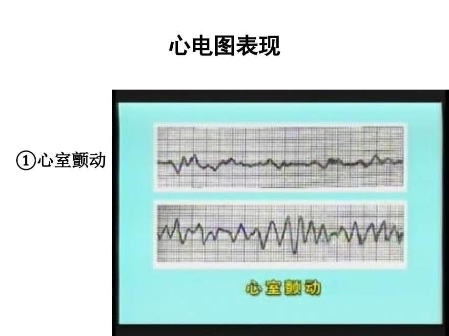 2014-2电除颤_第5页