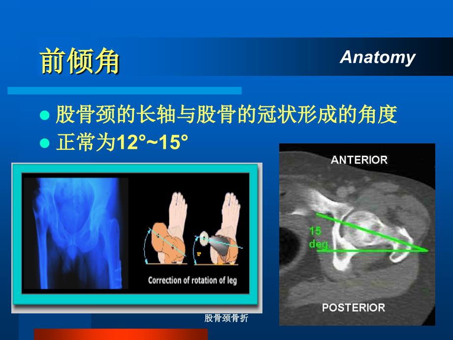 股骨颈骨折课件_第4页