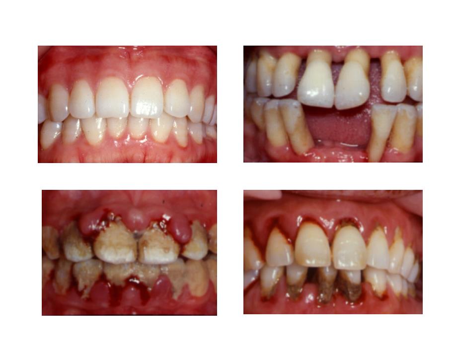 牙周病学课件：牙周病的病因学_第2页