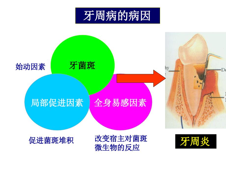 牙周病学课件：牙周病的病因学_第3页