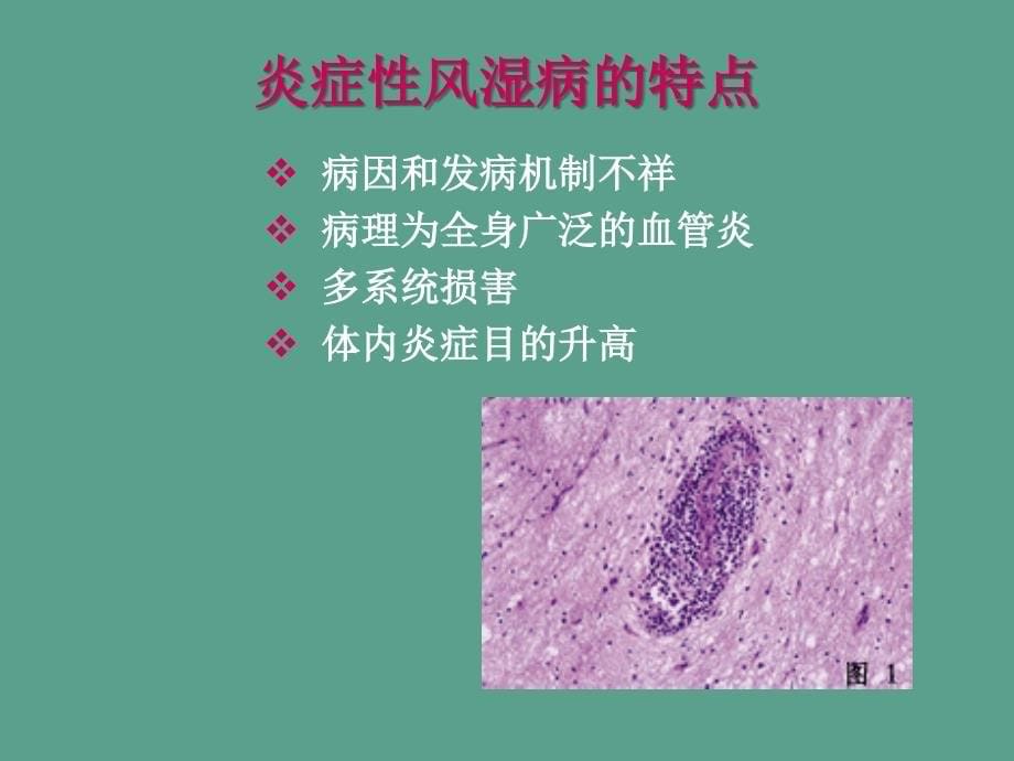 儿童风湿病ppt课件_第5页