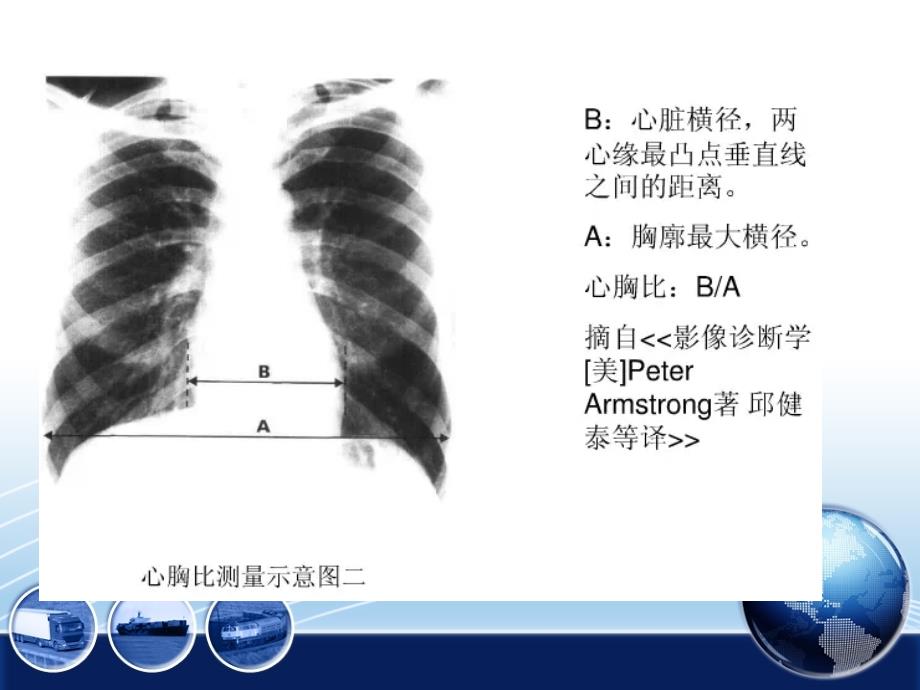 常见心脏病变的X线诊断_第4页