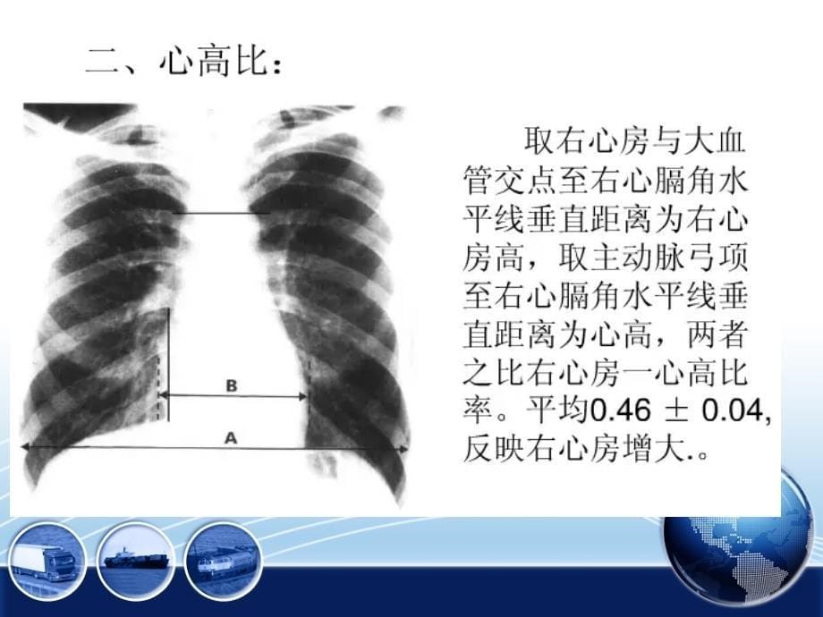 常见心脏病变的X线诊断_第5页