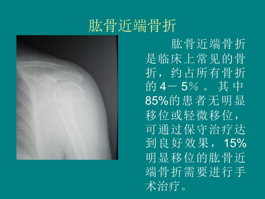 应用髓内针治疗肱骨外科颈骨折PPT课件_第2页