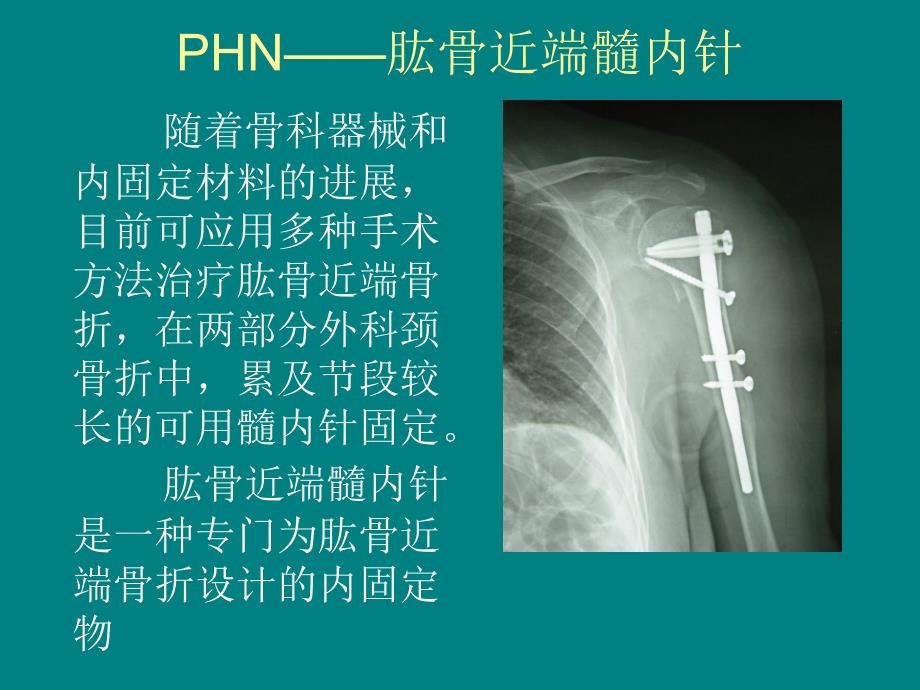 应用髓内针治疗肱骨外科颈骨折PPT课件_第3页