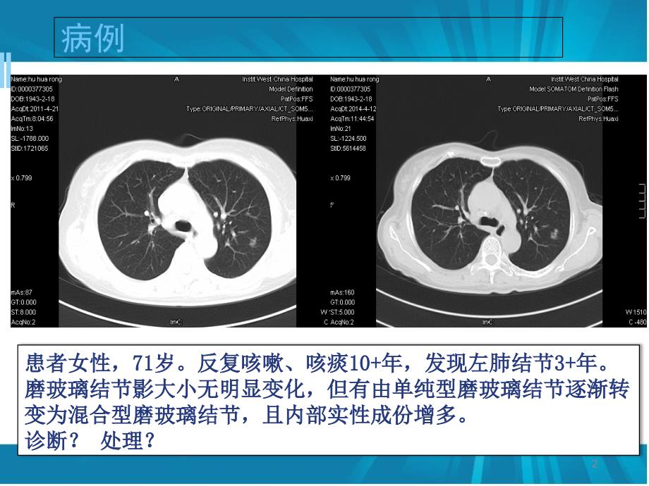 优质医学肺磨玻璃结节的诊断与临床处理策略_第2页