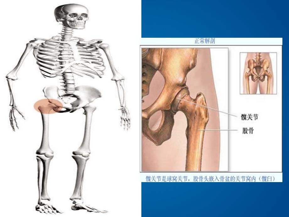 髋关节置换术护理PPT演示课件_第2页