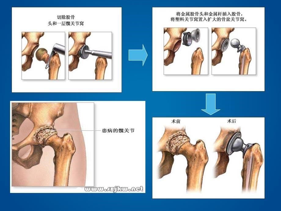 髋关节置换术护理PPT演示课件_第5页