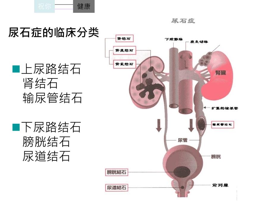 关于尿石症的预防_第3页