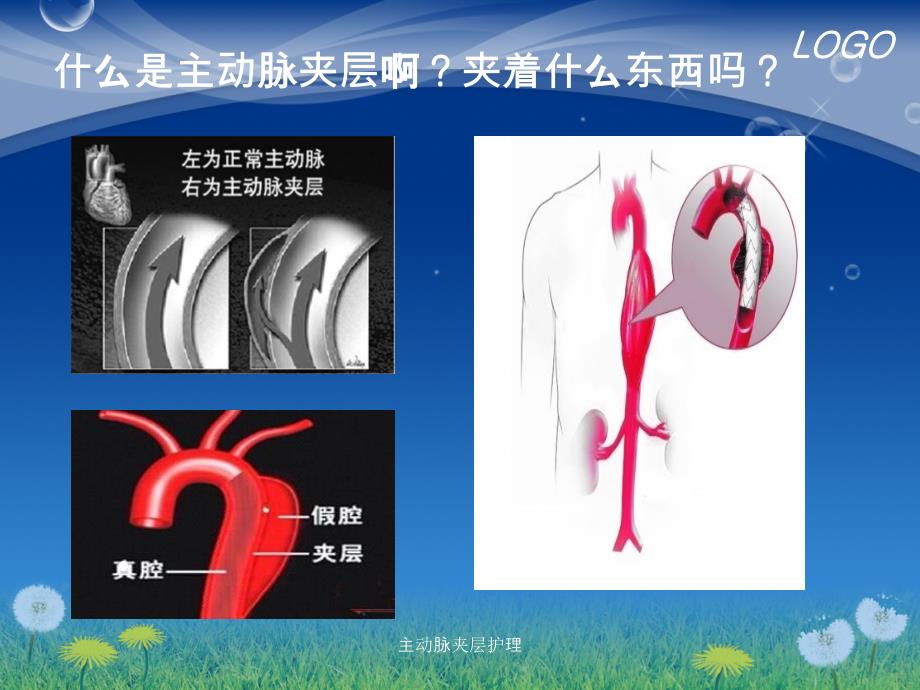 最新主动脉夹层护理_第4页