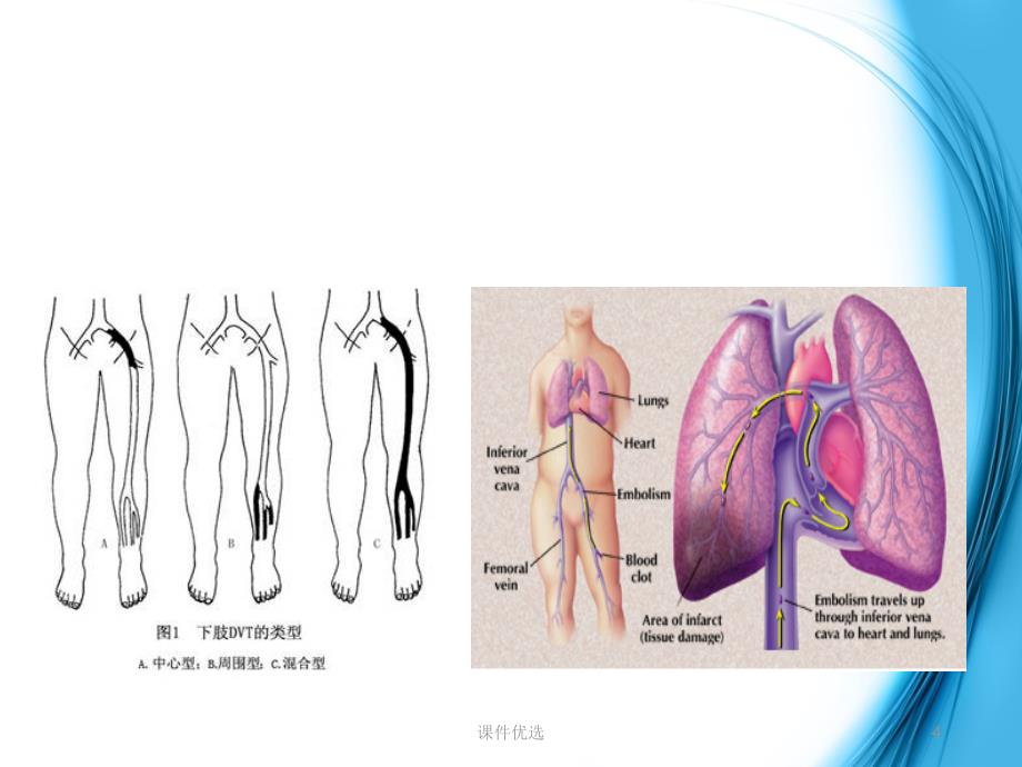 VTE的预防及护理行业内容_第4页