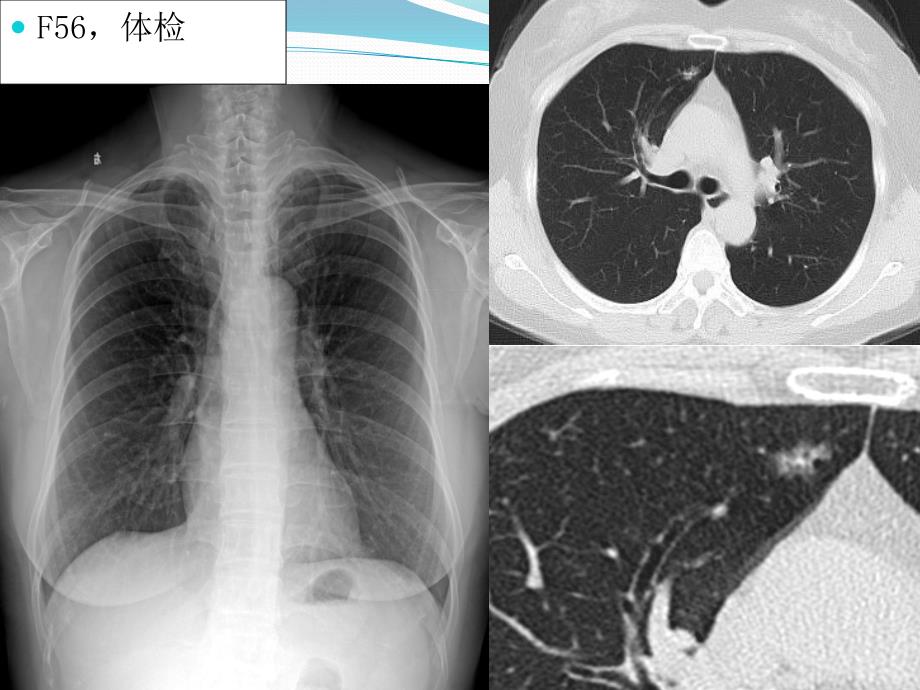 胸腔镜下肺部手术的护理配合_第2页