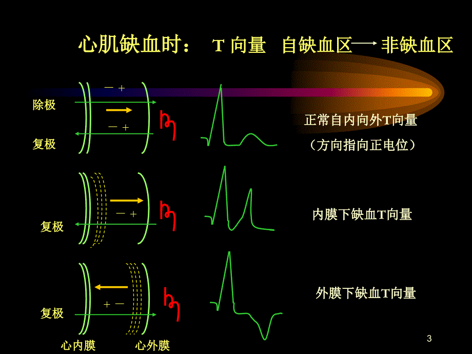 （优质课件）心肌缺血与心肌梗死的心电图改变.ppt_第3页