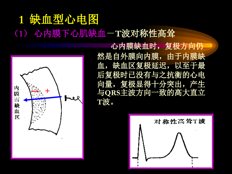 （优质课件）心肌缺血与心肌梗死的心电图改变.ppt_第4页