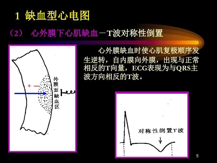 （优质课件）心肌缺血与心肌梗死的心电图改变.ppt_第5页