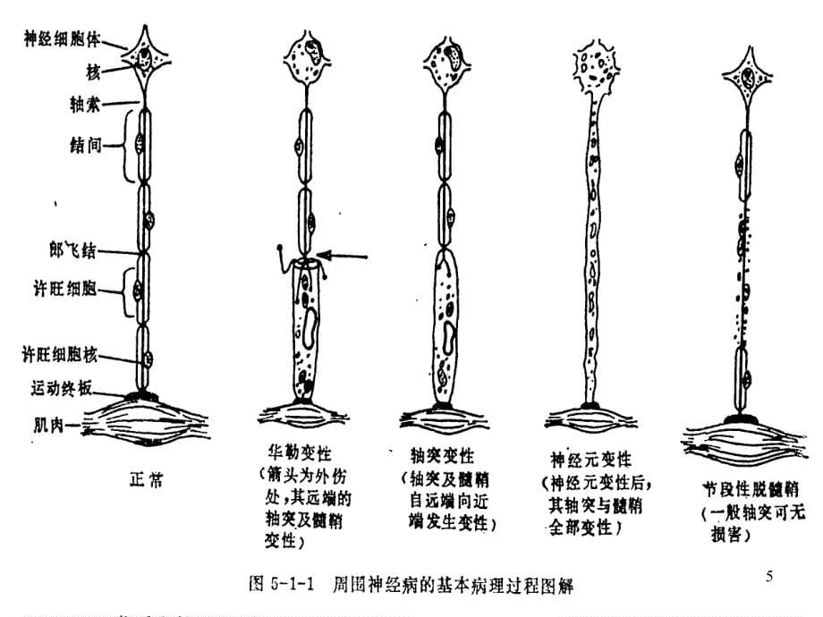 急性感染性多发性神经根炎_第5页