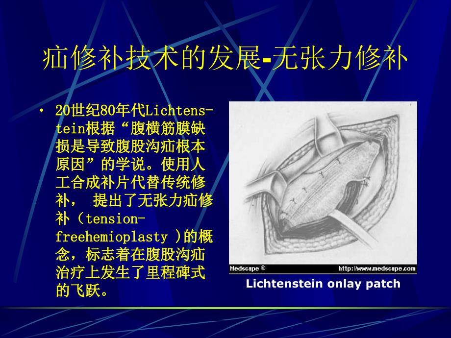 腹膜前间隙疝修补术_第2页