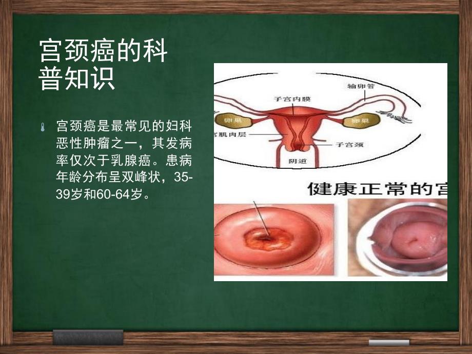 宫颈癌广泛性子宫切除盆腔淋巴结清扫手术配合_第2页