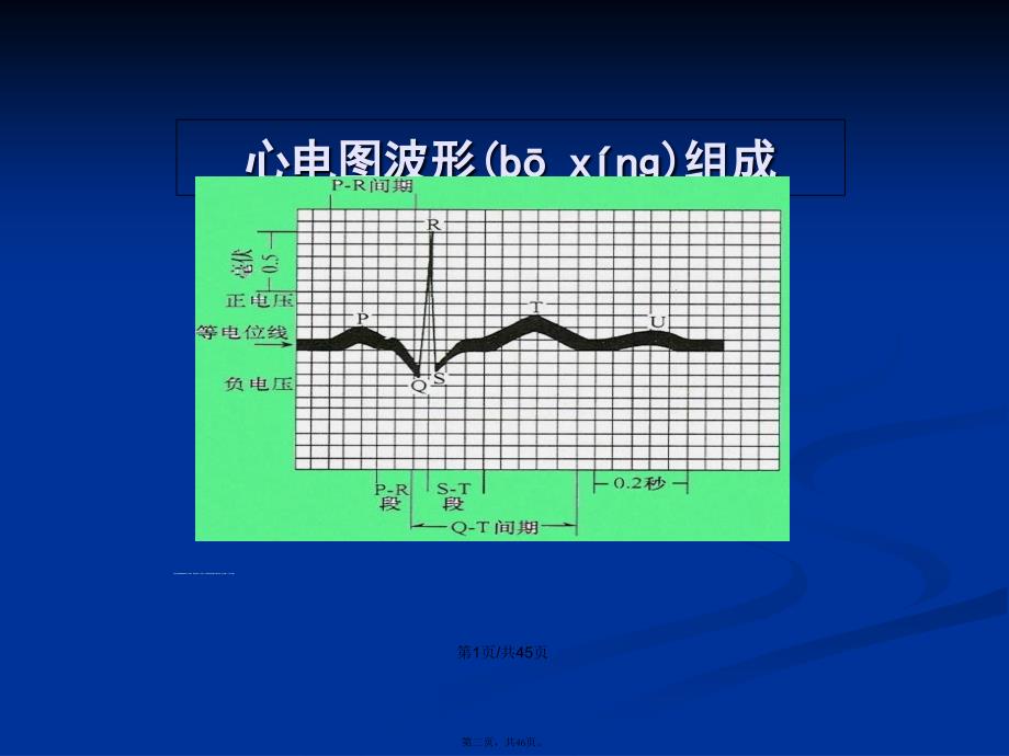 常见心律失常的心电图识别学习教案_第2页