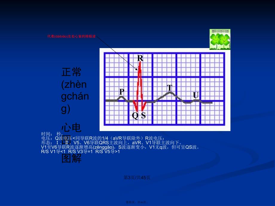 常见心律失常的心电图识别学习教案_第4页