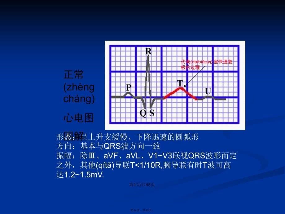 常见心律失常的心电图识别学习教案_第5页