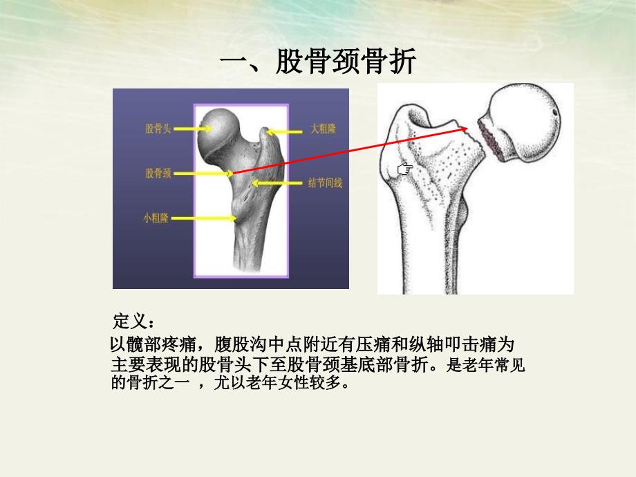 股骨颈骨折病人的护理介绍_第4页