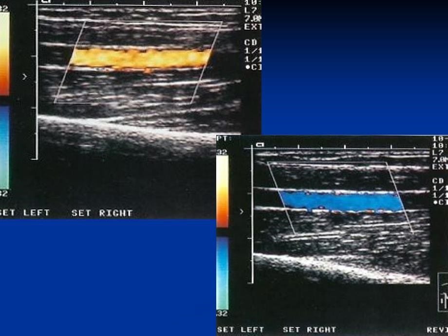 外周血管超声诊断讲稿.ppt_第5页