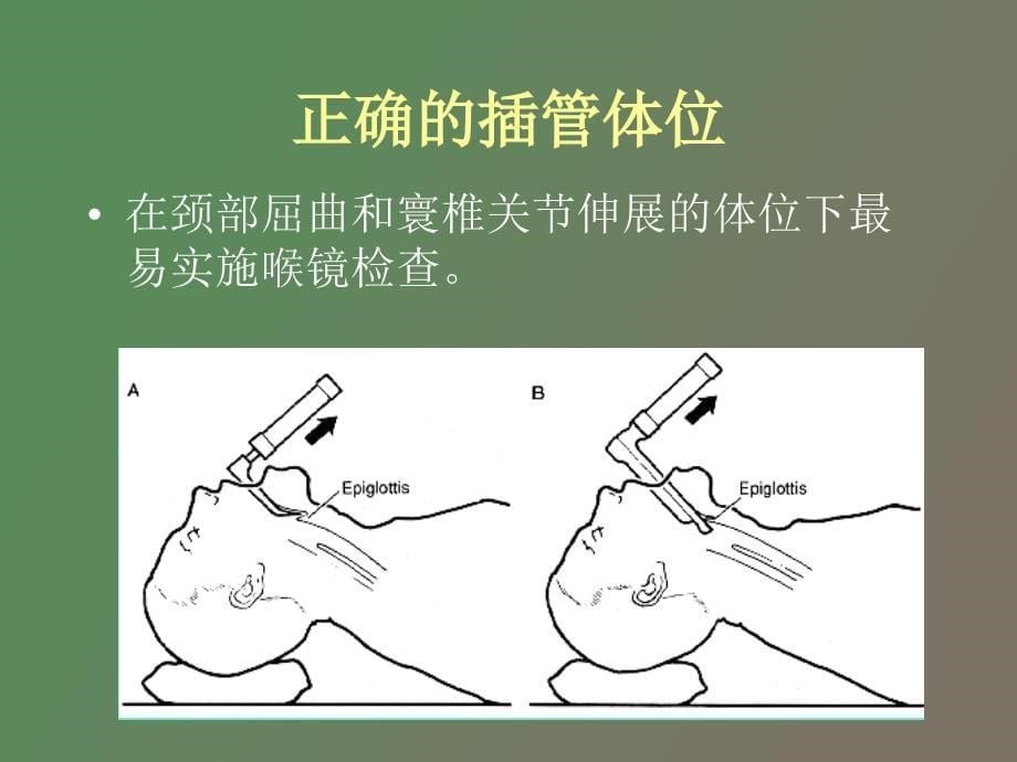 气管插管及气道管理_第5页