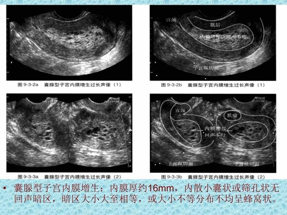 子宫内膜超声诊断.ppt_第5页