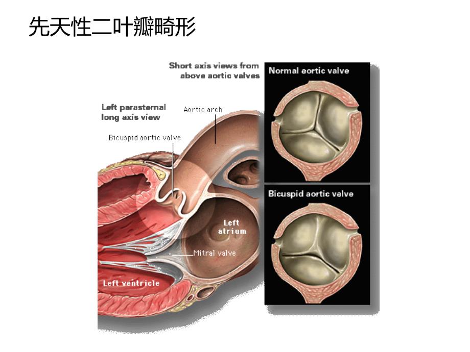 主动脉瓣狭窄PPT幻灯片.ppt_第3页