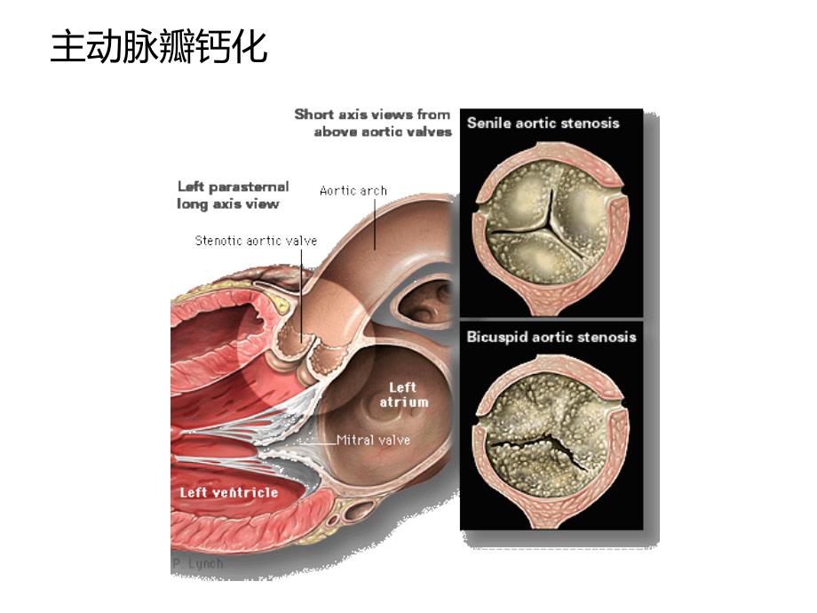 主动脉瓣狭窄PPT幻灯片.ppt_第4页