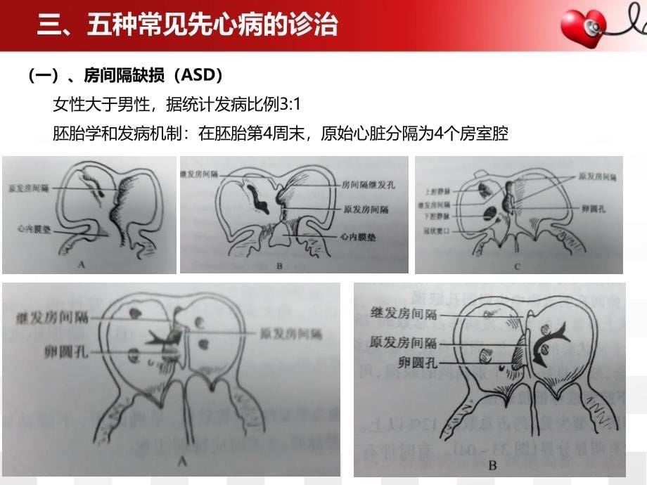 先天性心脏病诊治要点_第5页