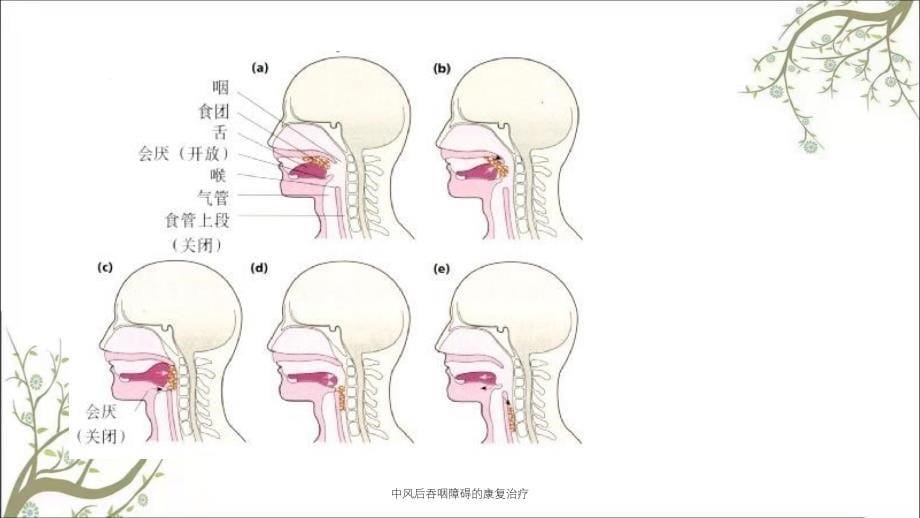 中风后吞咽障碍的康复治疗_第5页