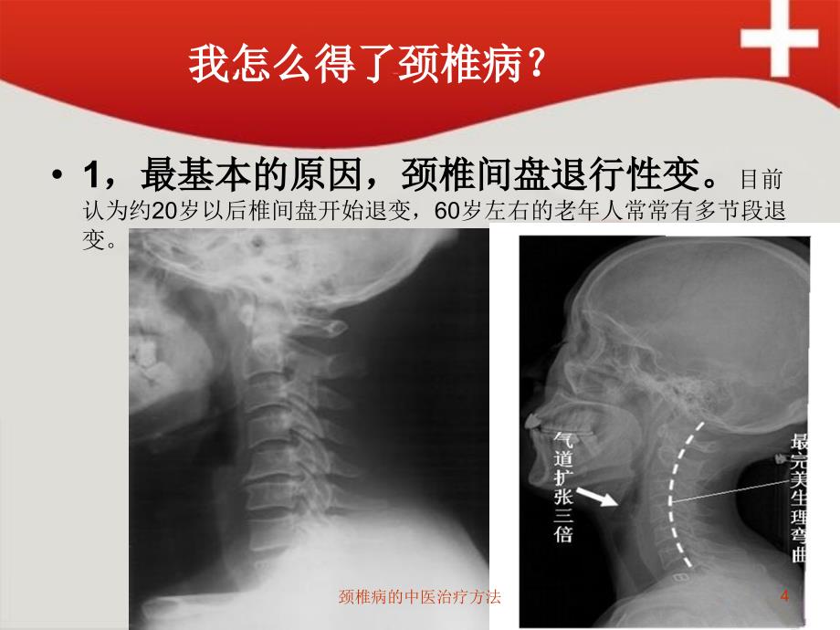 颈椎病的中医治疗方法培训课件_第4页