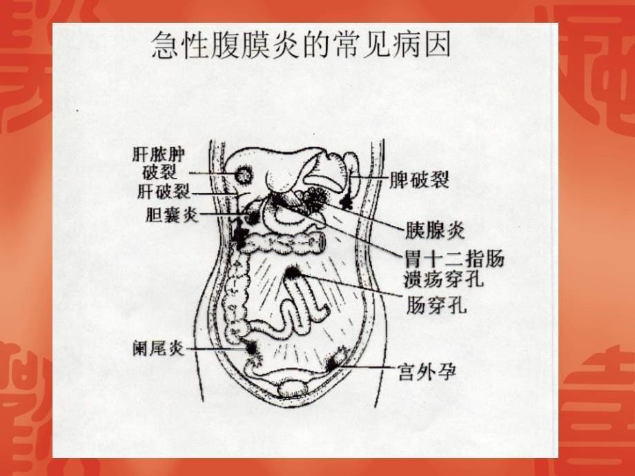 急性腹膜炎病人的护理.ppt_第5页