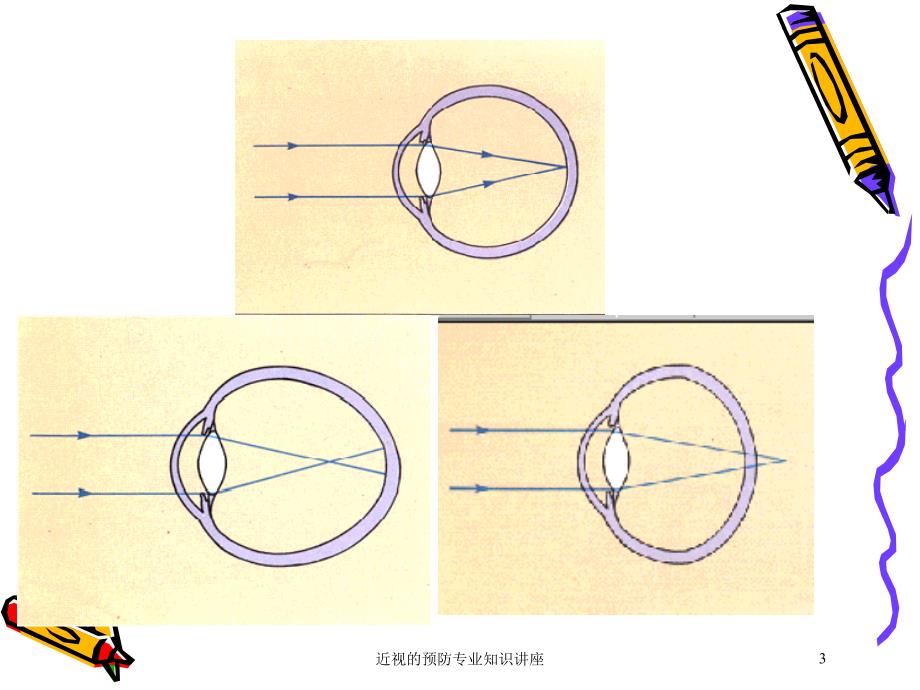 近视的预防专业知识讲座培训课件_第3页