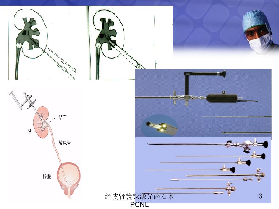 经皮肾镜钬激光碎石术PCNL培训课件_第3页