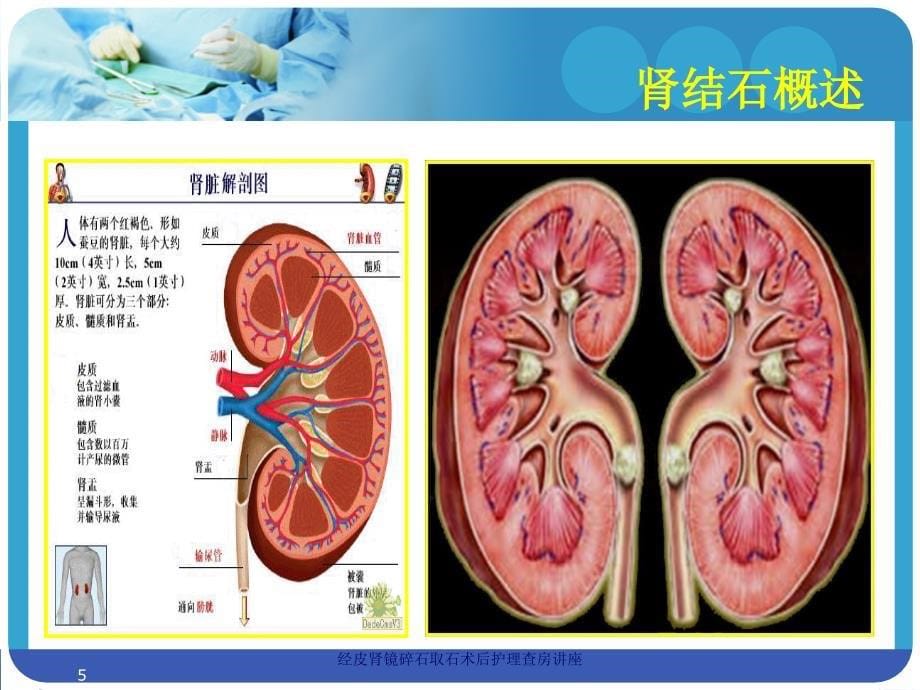 经皮肾镜碎石取石术后护理查房讲座培训课件_第5页